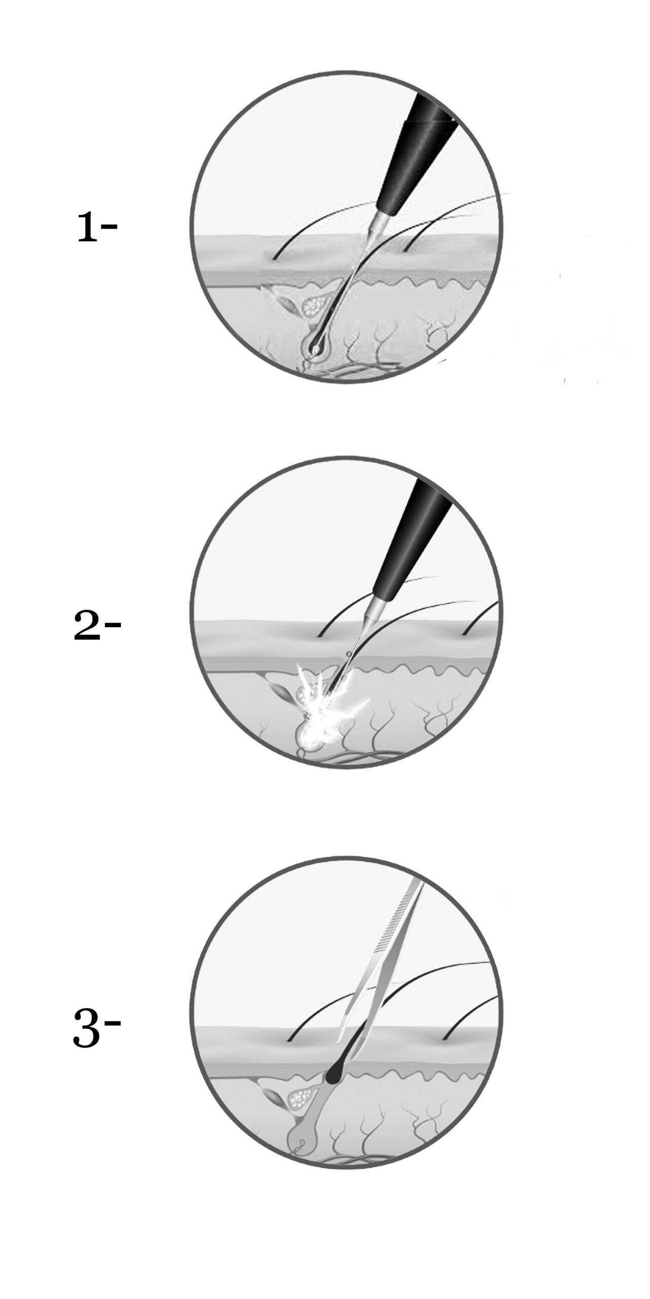 Schema en 3 etapes du fonctionnement de l'electrolyse definitive, BE Esthetic